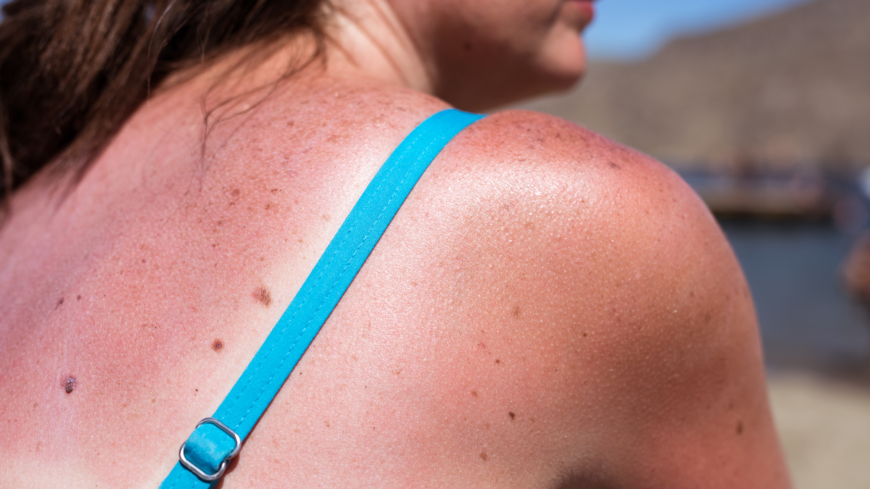 Att man bränner sig i solen ökar risken för melanom, en form av hudcancer. Ny forskning visar att risken att insjukna i fler än ett melanom har ökat markant. Foto: Shutterstock